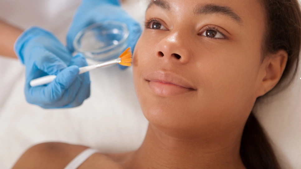 Professional facial peeling treatment being applied with a brush, promoting smoother, refreshed skin texture.