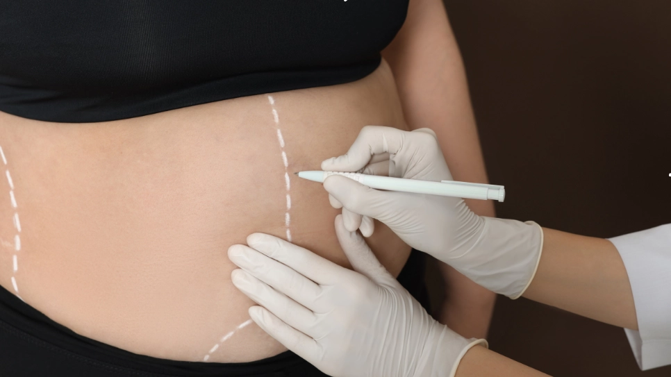 A close-up of a medical professional marking targeted areas on a patient