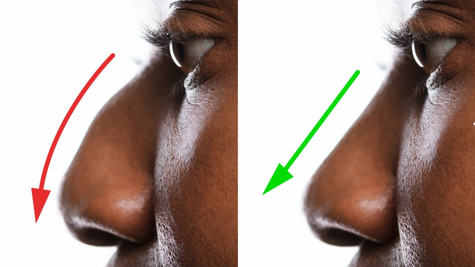 Side-by-side comparison showing before and after results of nose reshaping, highlighting changes in profile and contour.